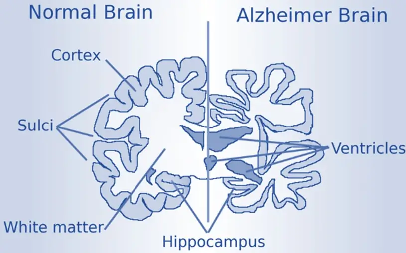 Alzheimer’s