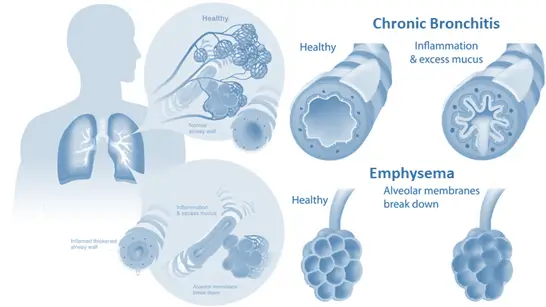 Chronic Obstructive