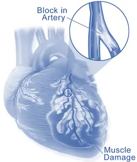 Myocardial infarction (MI)