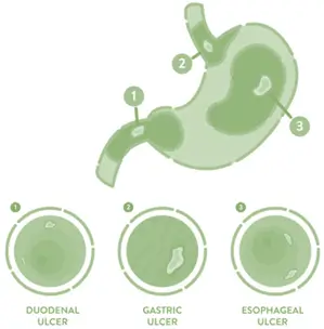 Peptic ulcer