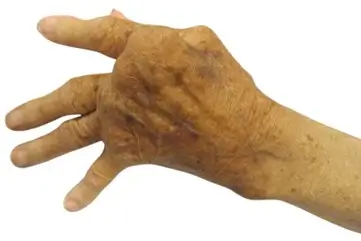 Rheumatoid 