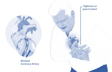 angina
