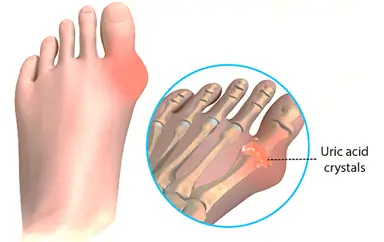 Gout Disease